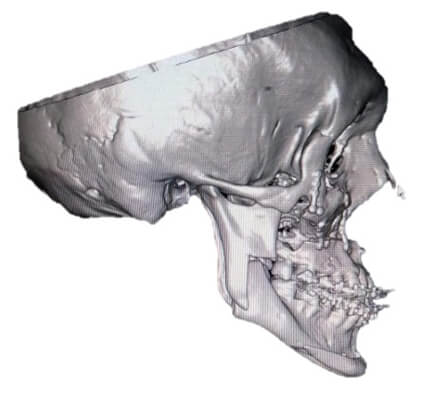 Fig 16. Tomografía final