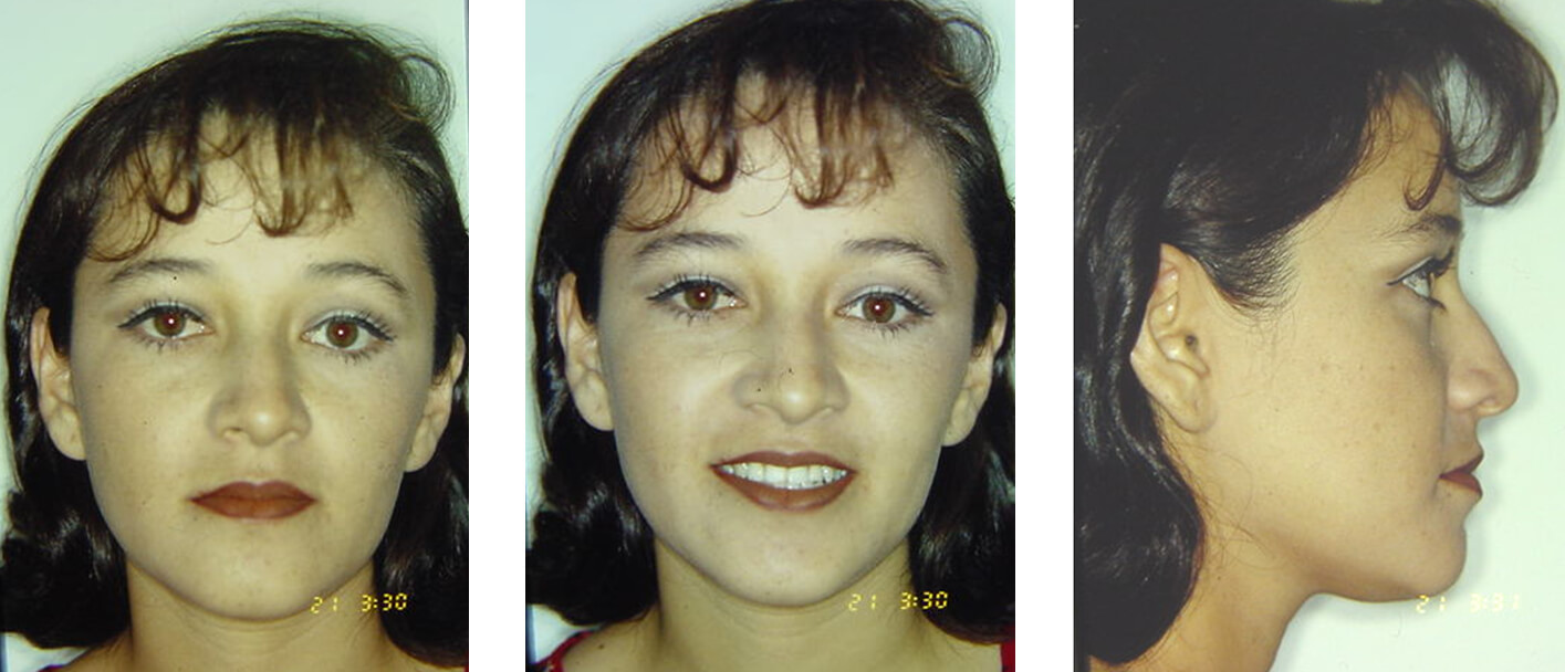 Fig. 19, 20 y 21