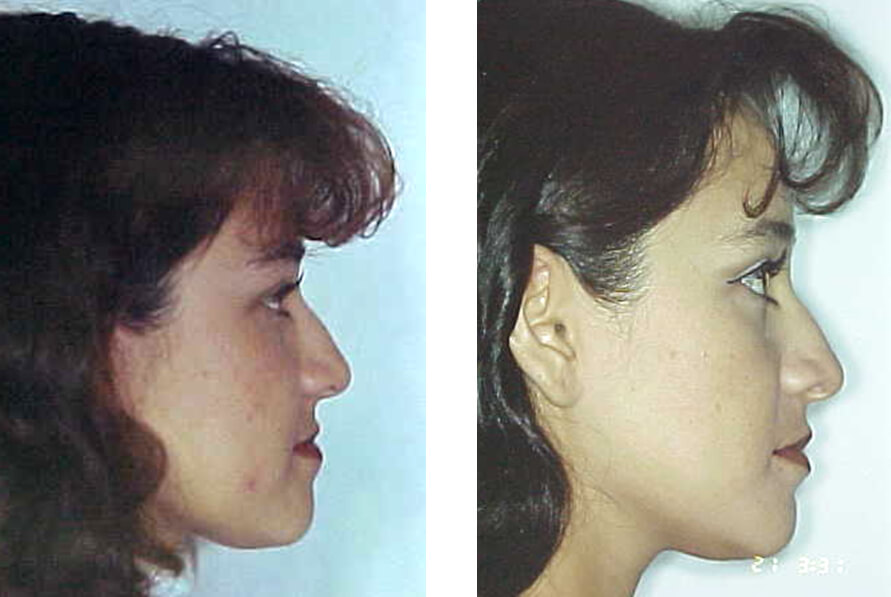 Fig. 27 y 28