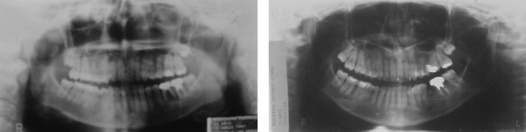 Fig. 29 y 30. Rxs panorámicas inicial y final.