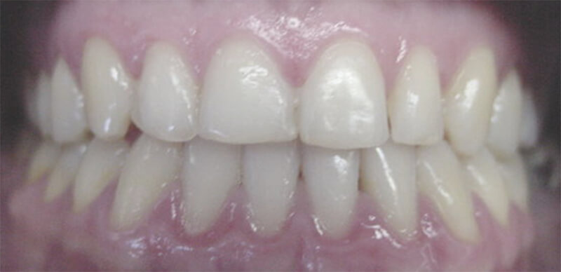 Fig. 38 POST-TRATAMIENTO