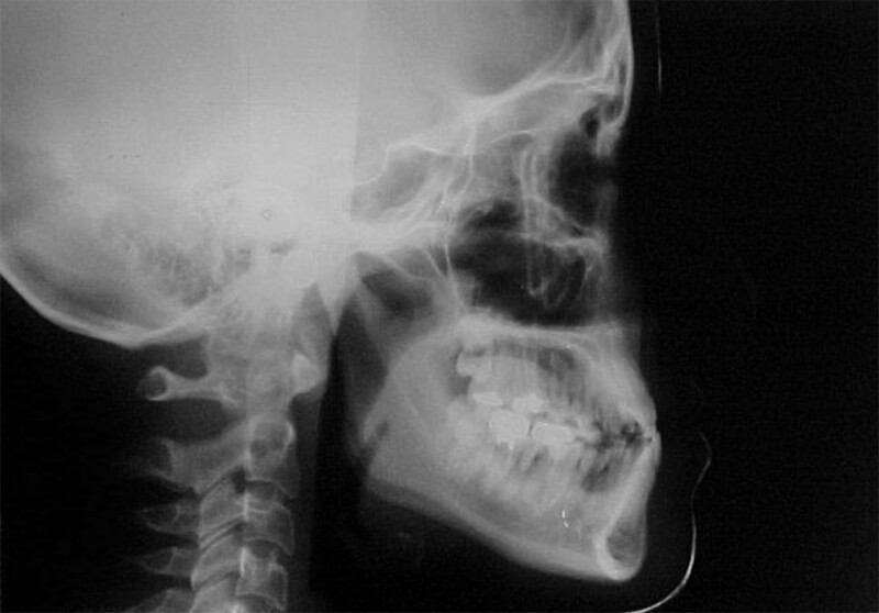 Fig. 39 Radiografía lateral Inicial