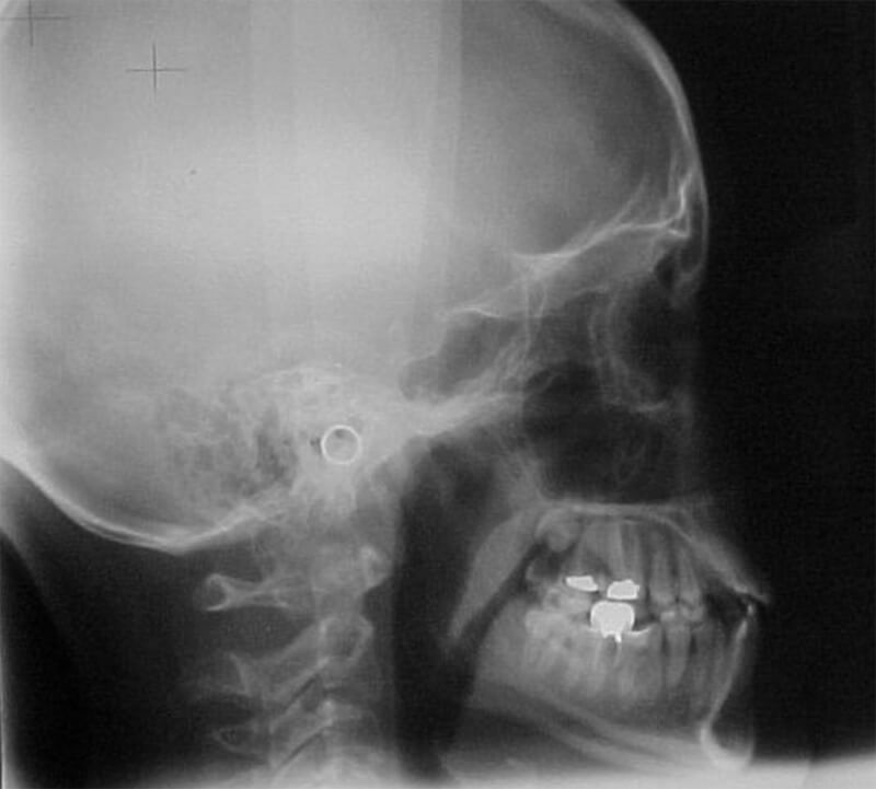 Fig. 40 Radiografía lateral final
