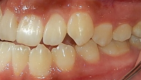 Fig. 5 intraoral izquierda