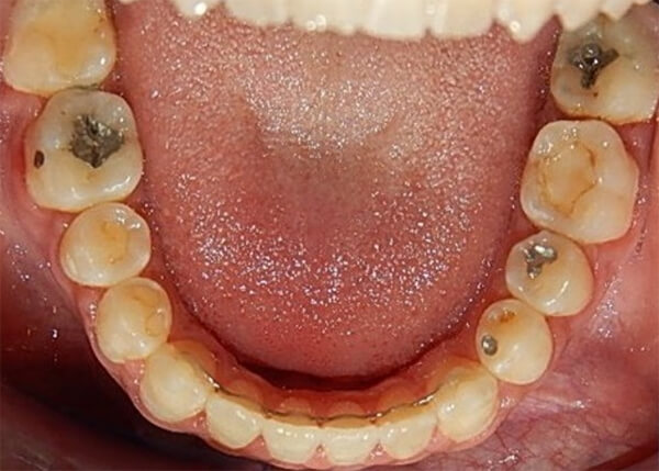 Fig. 19 oclusal superior final inferior