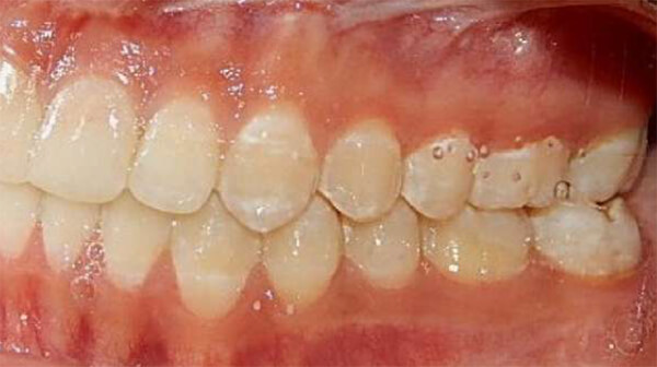 Fig. 11 Intraoral izquierda - final