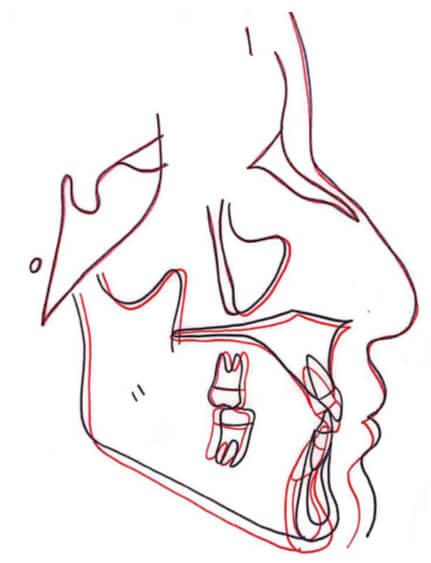 Fig. 14 Sobreimposición inicio, final
