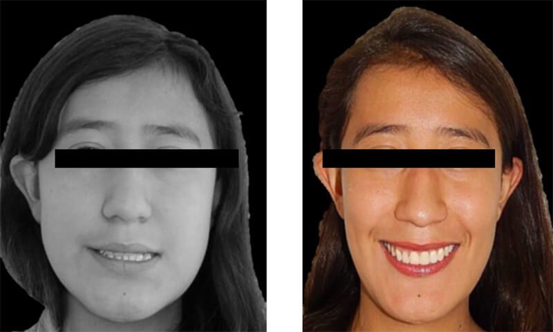 Fig. 15 frente Inicio final