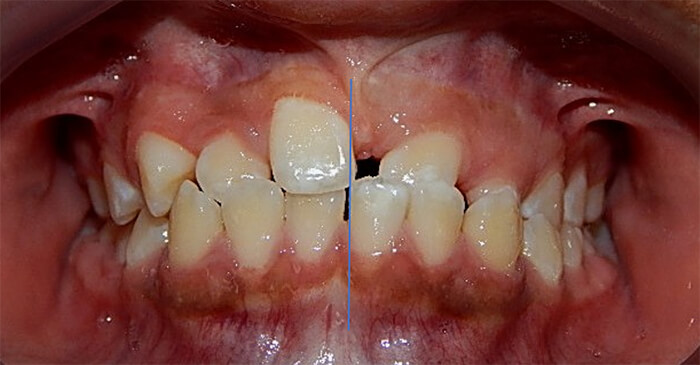 Fig. 3 intraoral de frente