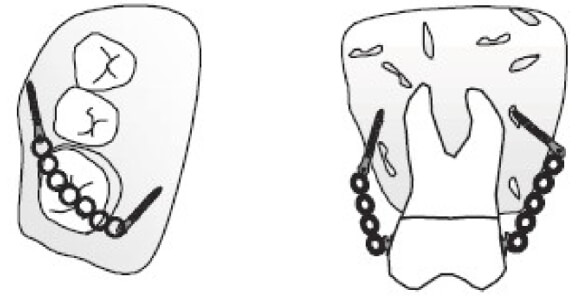 Figura 2 Intrusión de molares https://gredos.usal.es/bitstream/handle/10366/137403/TG_VazquezSantar%C3%A9n_Marina_microimplantescomoanclaje.pdf?sequence=1&isAllowed=y