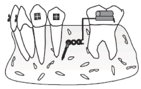 Figura 4 Mesialización de molares https://gredos.usal.es/bitstream/handle/10366/137403/TG_VazquezSantar%C3%A9n_Marina_microimplantescomoanclaje.pdf?sequence=1&isAllowed=y