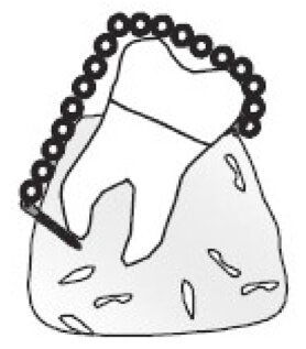 Figura 5 Vestibularización de molares inferiores https://gredos.usal.es/bitstream/handle/10366/137403/TG_VazquezSantar%C3%A9n_Marina_microimplantescomoanclaje.pdf?sequence=1&isAllowed=y