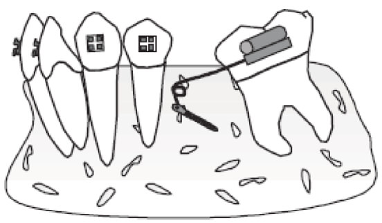 Figura 6 Verticalización de molares https://gredos.usal.es/bitstream/handle/10366/137403/TG_VazquezSantar%C3%A9n_Marina_microimplantescomoanclaje.pdf?sequence=1&isAllowed=y