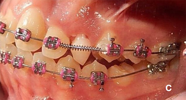 Fig. 10 C Vista lateral de progreso, en el que se mejora el overjet y overbite