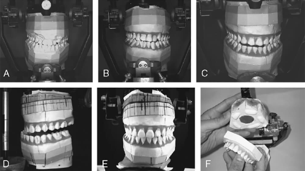 A.-Montaje de modelos en articulador semiajustable con 3 bases que permitirá separar la parte dental de los modelos. B.-Los modelos preoperatorios iniciales se reemplazan con un set up para predecir los movimientos dentales, la descompensación del incisivo, y coordinación del arco. C.-Simulación del tratamiento de ortodoncia postoperatorio que permitirá proporcionar una base para la estimación de la cantidad de movimiento del maxilar y la mandíbula. D y E.-Movimiento de modelos maxilar y mandibular de acuerdo al objetivo visual de tratamiento (VTO) quirúrgico. F.-Los set ups se reemplazan con los modelos preoperatorios iniciales para la fabricación de férulas intermedias y finales.