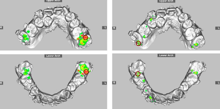 Figura 3.-Oclusograma con mapa de color 3D que muestra la reducción del contacto dental en región posterior (color rojo y verde) debido a la creación de contacto anterior (color verde), este es un paso importante adoptado para la configuración de la oclusión quirúrgica en el abordaje de cirugía primero.