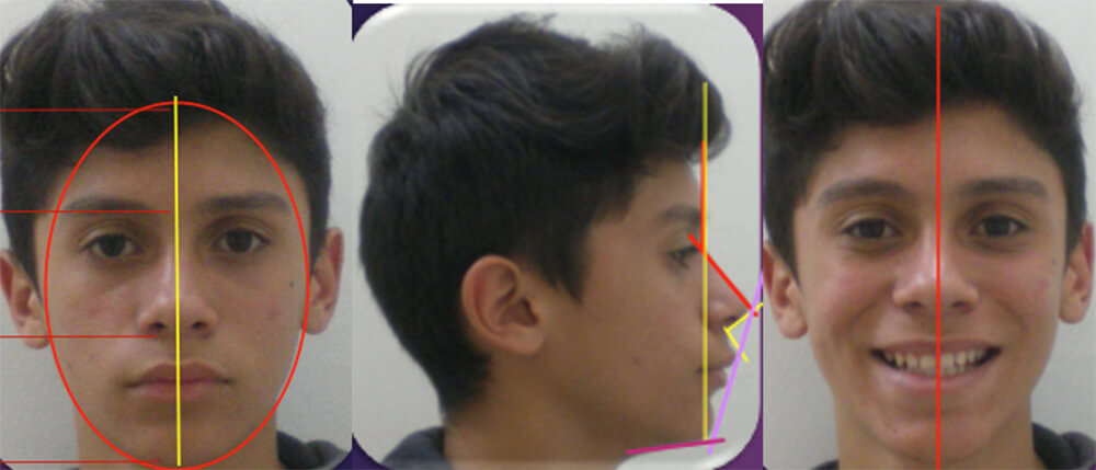 Fig 1 Análisis Extraoral