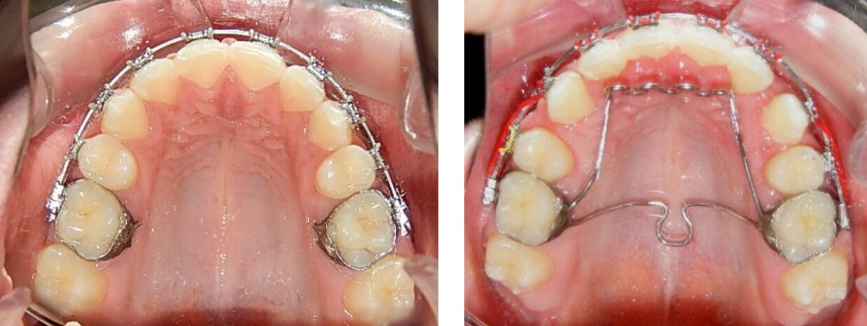 Fig. 4 Vista oclusal con ATP modificado con trampa lingual