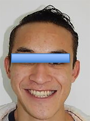 Fig. 3 Patrón dolicofacial