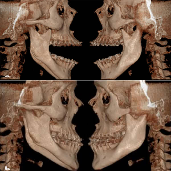 Fig. 18 boca abierta y cerrada