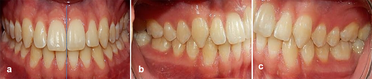 Fig. 23 (a) frente intraoral final, (b) derecha intraoral final; (c) izquierda