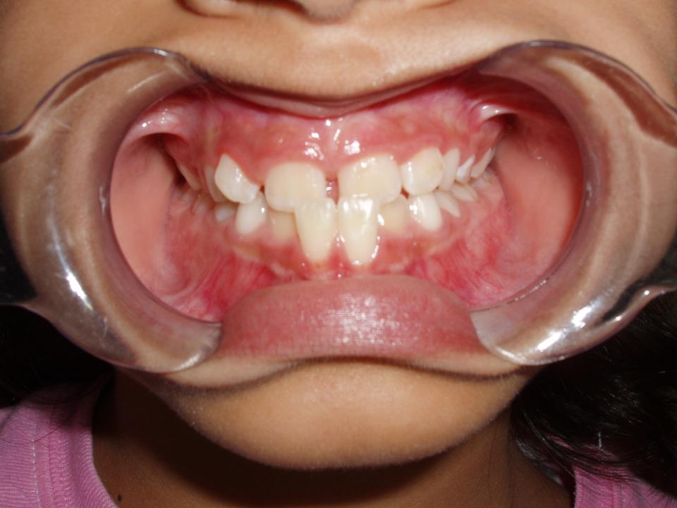 Figura 4: Mordida cruzada de 11-21-31-41. Observe la recesión gingival en 31 y 41.