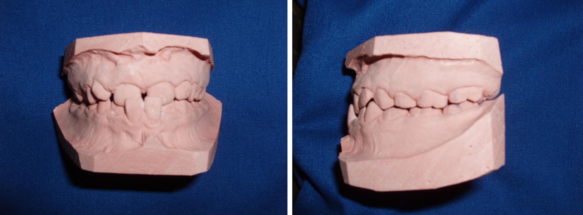 Fig.6: Relación Molar y Canina Clase I en máxima intercuspidación.