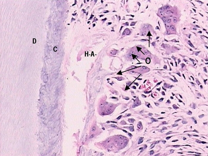 TESTIGO CON ESTRÉS MECANICO A LAS 24 HRS. Figura 1.Técnica H y E. Testigo con estrés mecánico a las 24 hrs. Donde reobservan gran cantidad de osteoclastos adheridos al hueso en el espacio medular adyecente ( O: osteoclastos, C:cemento, D: dentina, H.A.: Hueso alveolar)