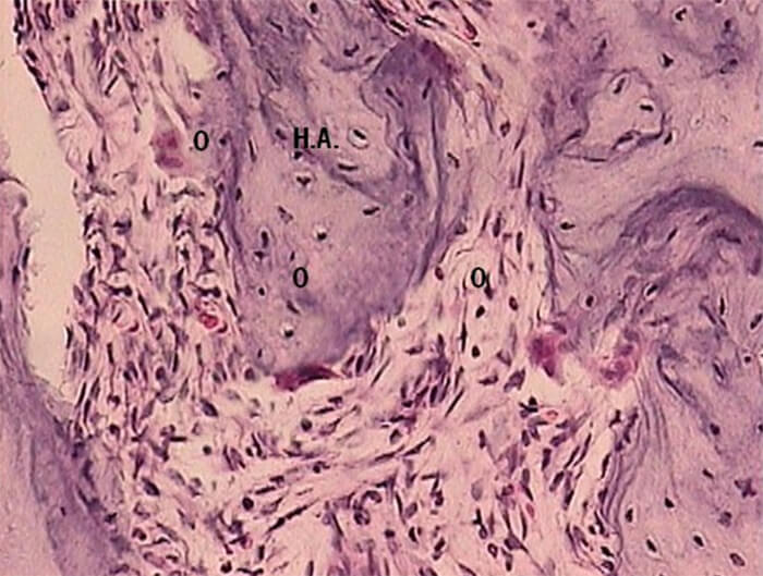EXPERIMENTAL DICLOFENACO 24 HRS. Figura 2 Técnica H y E. Experimental diclofenaco a las 24 hrs. donde se observan osteoclastos adheridos al hueso en el espacio medular adyacente ( O: osteoclastos; H.A.: hueso alveolar)