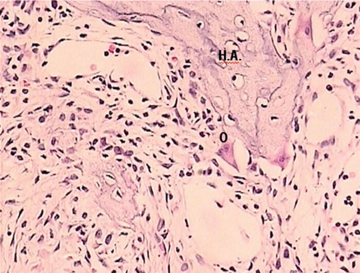 EXPERIMENTAL DICLOFENACO 48 HRS Figura 3. Técnica H y E. Experimental diclofenaco a las 48 hrs. donde se observan osteoclastos adheridos al hueso en el espacio medular adyacente ( O: osteoclastos; H.A.: hueso alveolar)