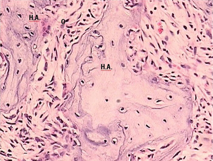 EXPERIMENTAL DICLOFENACO 72 HRS. Figura 4. Técnica H y E. Experimental diclofenaco a las 72 hrs. donde se observan osteoclastos adheridos al hueso en el espacio medular adyacente ( O: osteoclastos; H.A.: hueso alveolar)