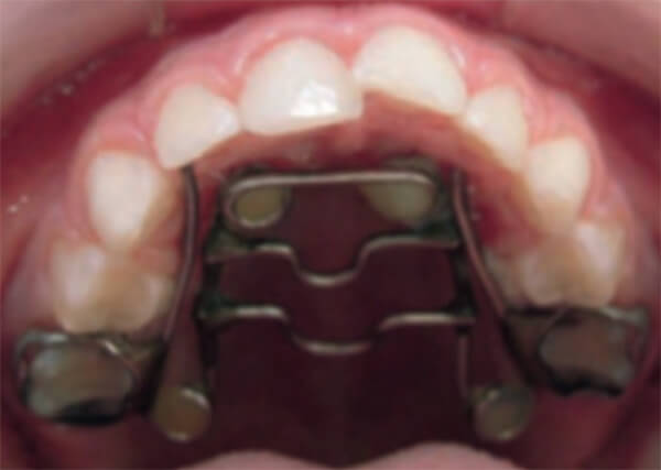 Figura 1 Quad Helix antidedo. Aparato de ordodoncia metaliuco fijo que obstruye al dedo tocar el paladar para evitar el vacio que proivoca la union entre estos.