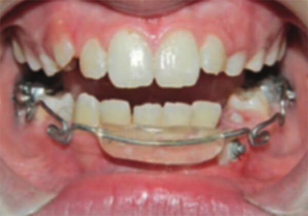 Figura 2 Escudillo vestibular. Pantalla acrilica que separa los dientes de la mucosa labial.