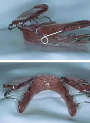 Figura 2 Vista lateral y posterior del bloque de intrusión posterior donde pueden apreciarse os distintos elementos que le conforman