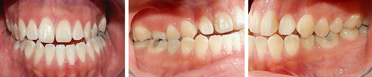 Fig. 4 frente Lateral derecha e izquierda