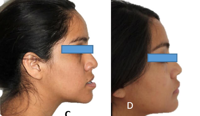 Fig. 9 C Perfil pre-quirúrgica C y post-quirúrgica D