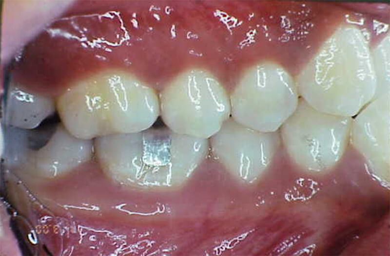 Fig. 4 Clase I molar y canina derecha