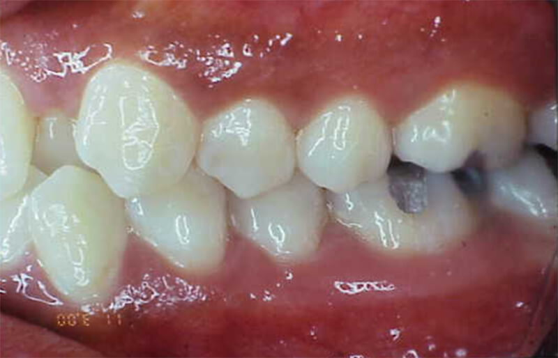 Fig. 5 Clase I molar y canina izquierda