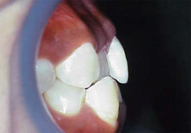 Fig. 6 Over jet y over bite en norma