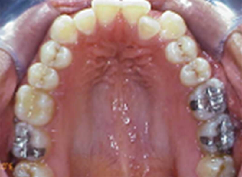 Fig. 7 Linguoversión del 22