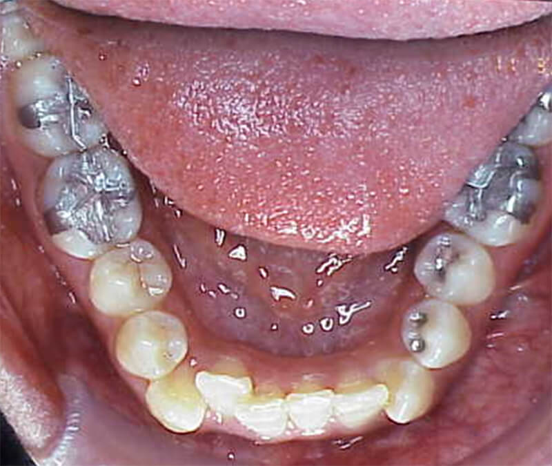 Fig. 8 Linguoversión del 42