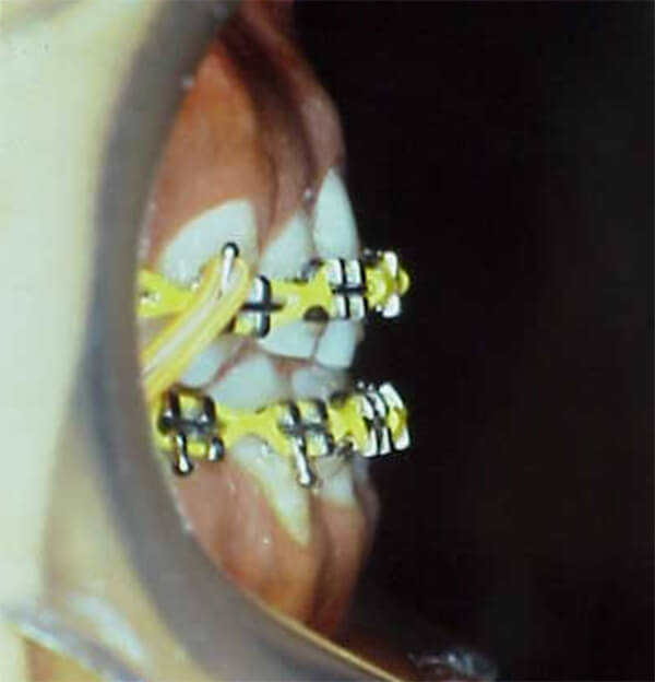 Fig. 17