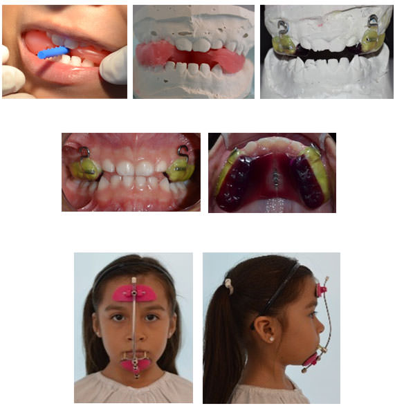 Imagen 2. Elaboración y colocación de aparato intraoral y máscara facial