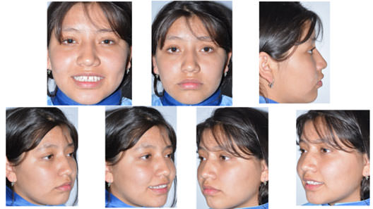 Fig. 1 fotografias extraorales iniciales