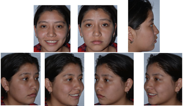 Fig. 3 fotografias extraorales finales