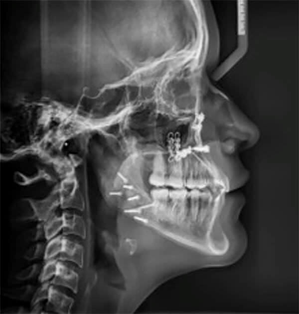 Fig. 12 En la radiografía panorámica postratamiento se ve que se ma