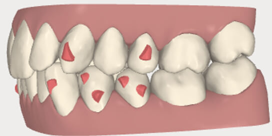 Figura 1 Ataches elipsoidales solos para desrotaciones y en parejas utilizados para realizar movimientos de raíces.