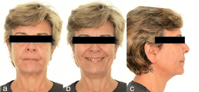 Figura 1.- Fotografías  Extraorales Iniciales. a) Frontal b) Sonriendo c) Perfil