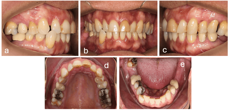 Figura 2.- Fotos Intraorales Iniciales. a) Lateral derecha b) Frontal c) Lateral izquierda d) Oclusal superior e) Oclusal inferior