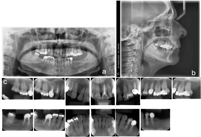 Figura 3.- Radiografías Iniciales a) Panorámica b) Telerradiografía lateral c) Periapical total
